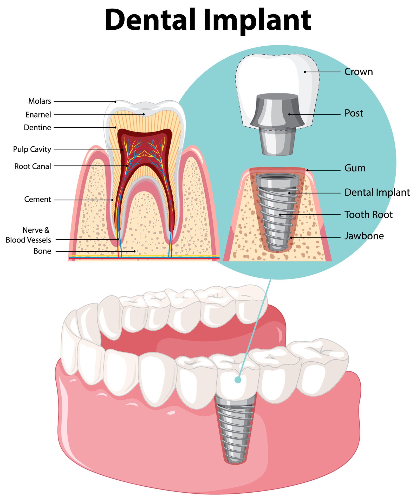 Best Dental Implant Clinic in virar