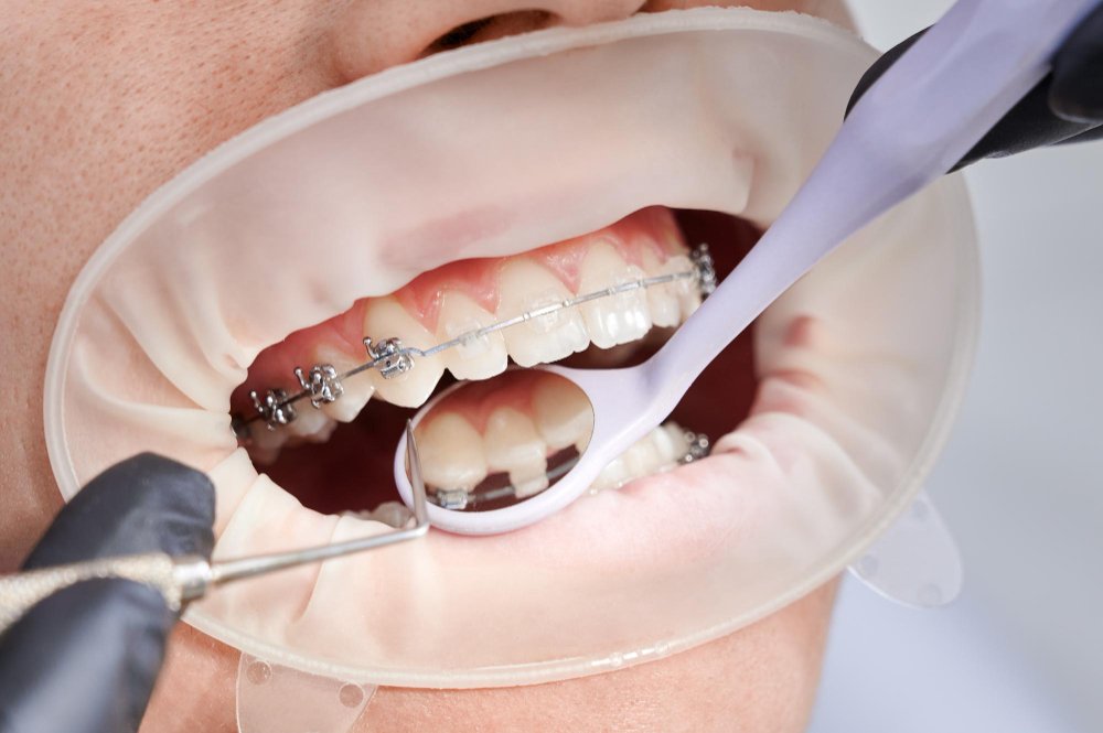 best teeth cleaning services in Virar