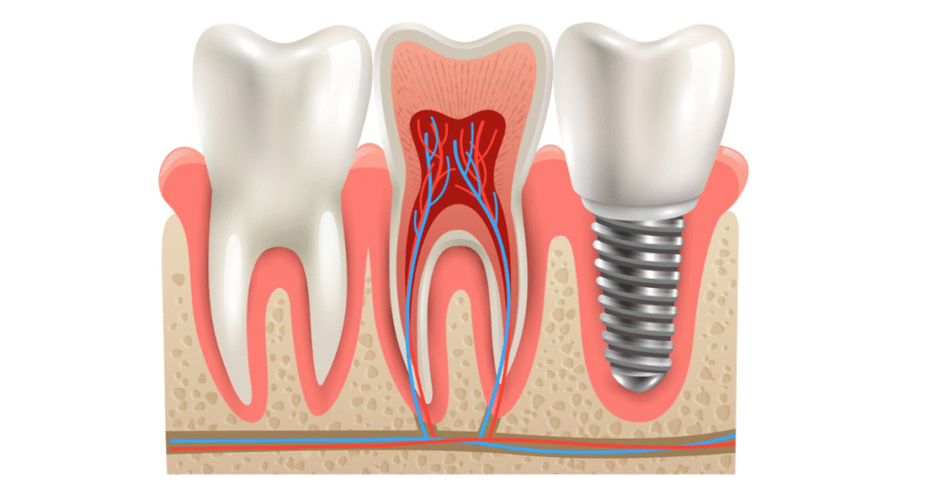 best dental implants in Virar