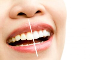 teeth whitening in Virar