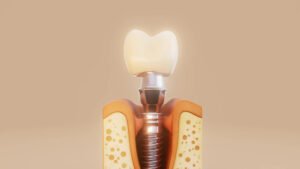 teeth implantation near Virar