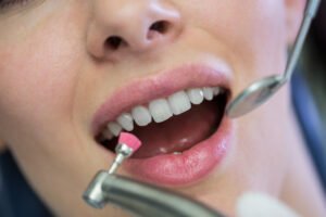 Teeth Whitening in Virar